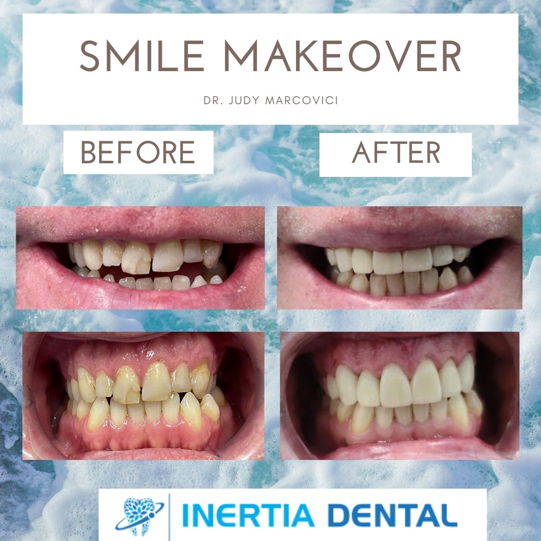 Smile Makeover Before and After