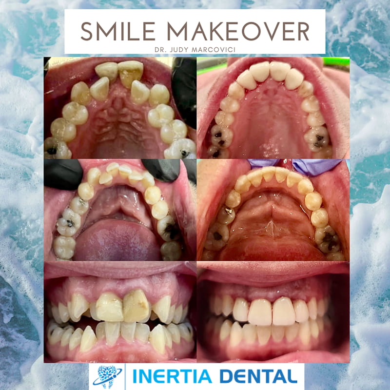 Smile Makeover Before and After