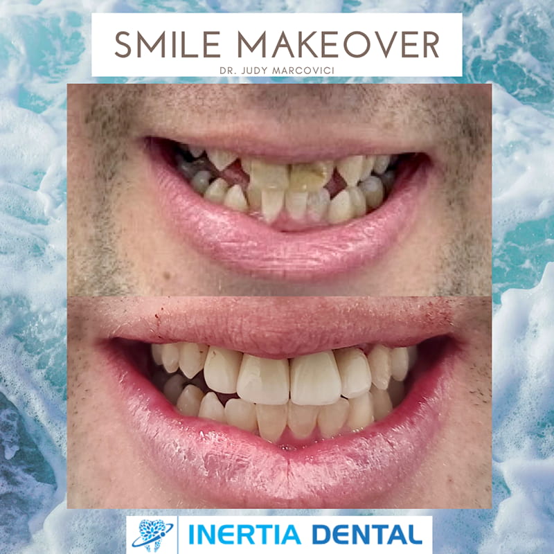 Smile Makeover Before and After