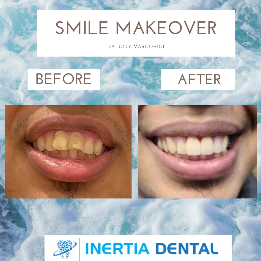 Smile Makeover Before and After