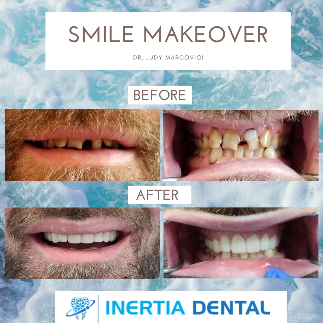 Smile Makeover Before and After