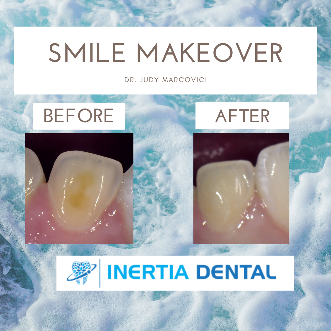 Smile Makeover Before and After