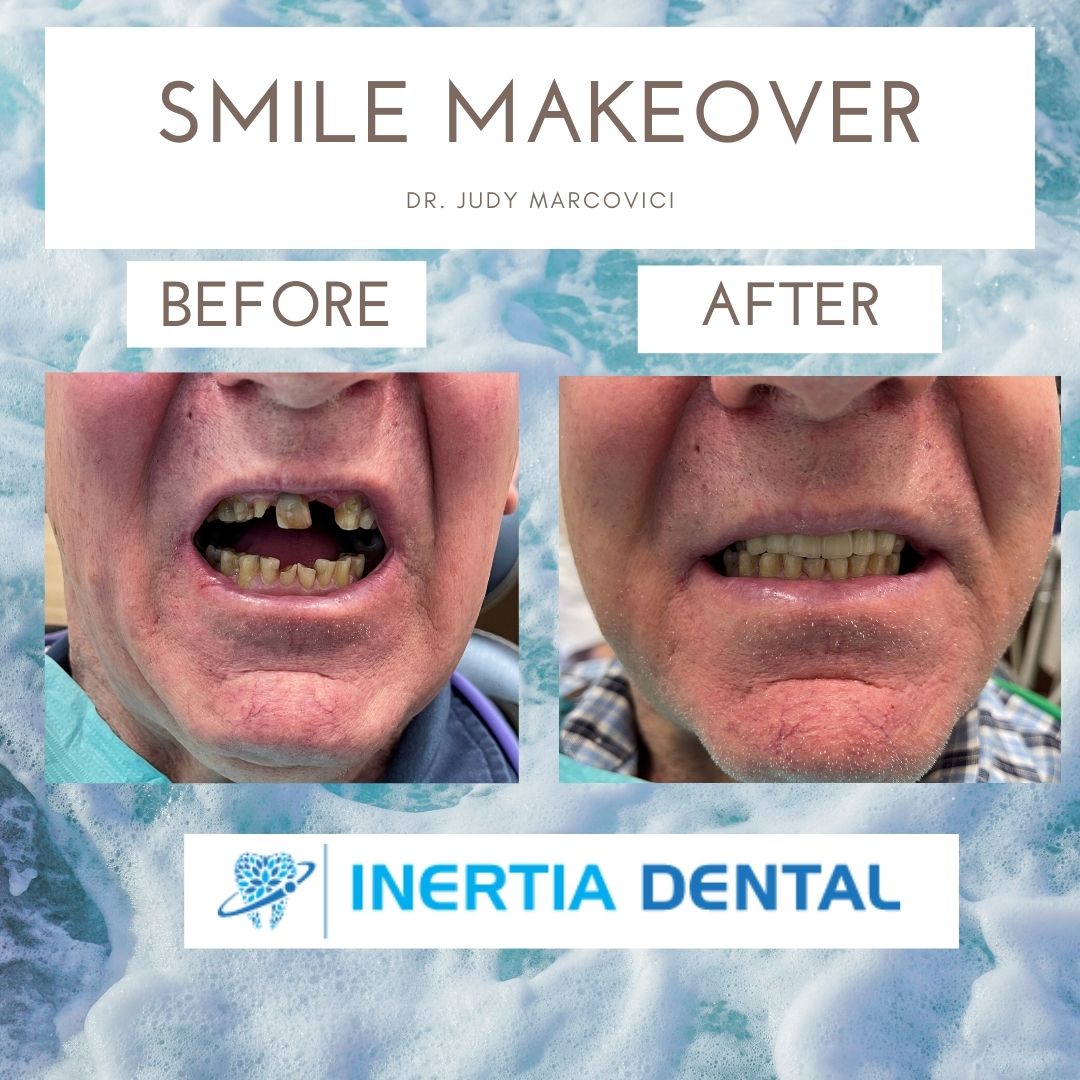 Smile Makeover Before and After